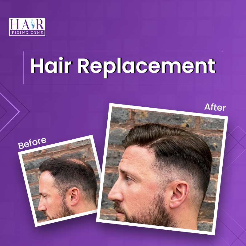 Hair Replacement for Men