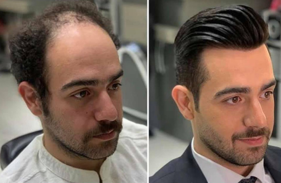 Hair Patches for Men in Bangalore