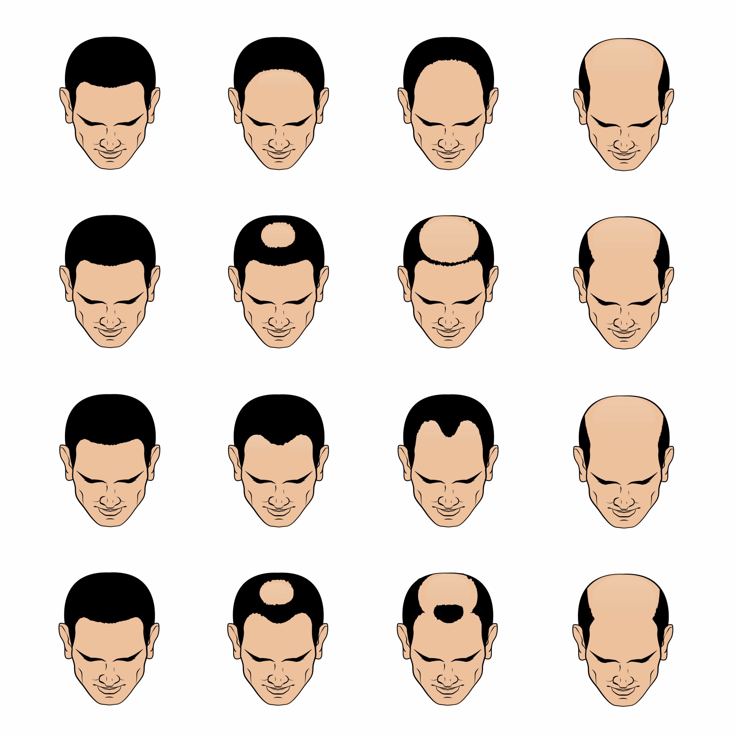 Hair Loss Treatment for Men | Hair Fixing Zone | Replacement | Weaving | Hair Extensions Hair Loss Treatment for Men | Hair Fixing Zone | Replacement | Weaving | Hair Extensions
