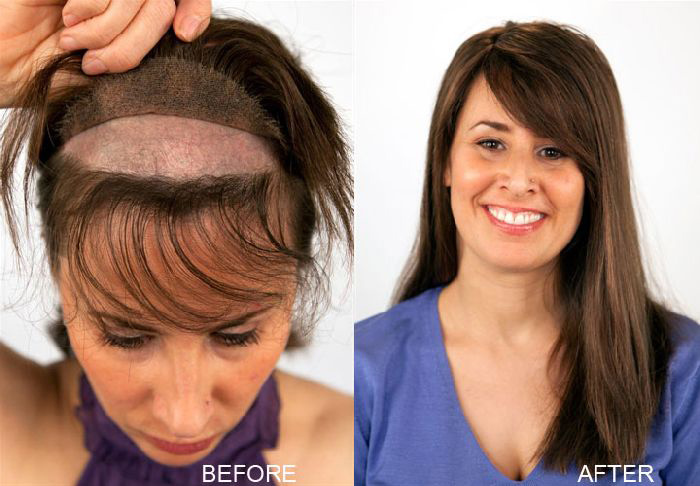 Hair Replacement for Women